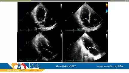 An 85-year-old man with progressive dyspnea after eating fish