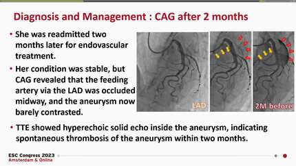 The aneurysm that vanished into thin air: Spontaneous thrombosis of a giant aneurysm complicated with the coronary to pulmonary artery fistula