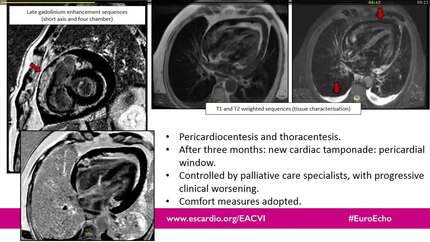 Dyspnea in 67-year-old man with stage IV prostatic adenocarcinoma. 