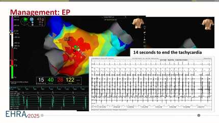 The curious incident of the atrial tachycardia in the night-time