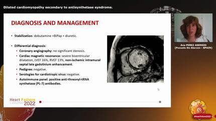 Dilated cardiomyopathy secondary to antisynthetase syndrome.