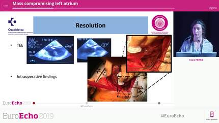 Mass compromising left atrium