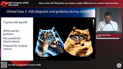 How a mini 4D TEE probe can make a major difference in cardiac interventions.