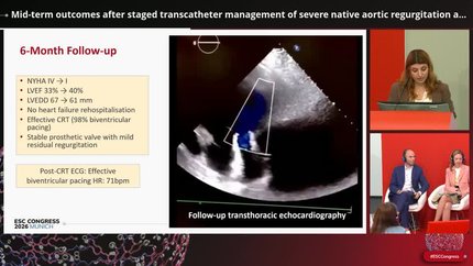 Mid-term outcomes after staged transcatheter management of severe native aortic regurgitation and cardiac resynchronisation therapy in a high-risk patient