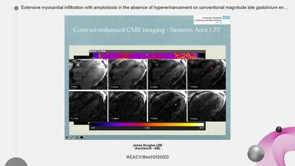 Extensive myocardial infiltration with amyloidosis in the absence of hyperenhancement on conventional magnitude late gadolinium enhancement cardiovascular imaging.
