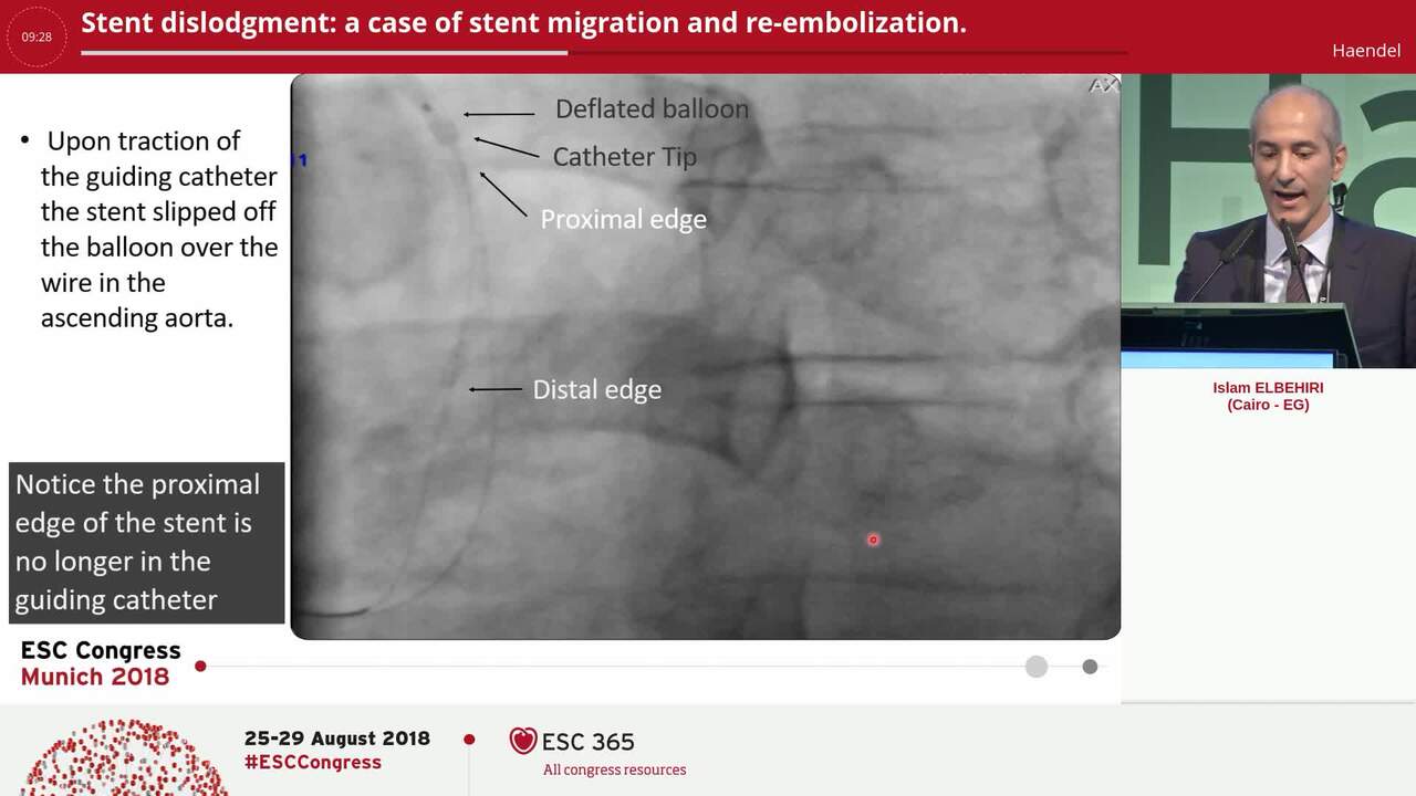 Stent dislodgment: a case of stent migration and re-embolization.