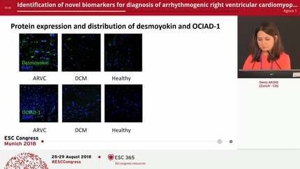 Identification of novel biomarkers for diagnosis of arrhythmogenic right ventricular cardiomyopathy using transcriptomics and label-free proteomics 