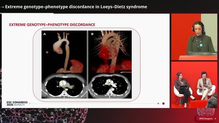 Extreme genotype–phenotype discordance in Loeys–Dietz syndrome