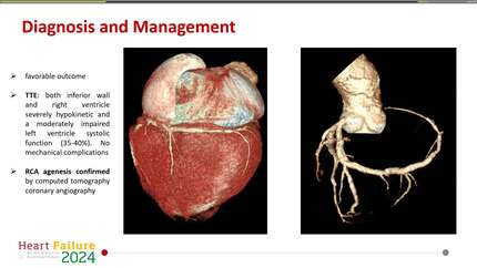 A case of de novo diagnosis of right coronary artery agenesis during an inferior ST-segment elevation myocardial infarction 