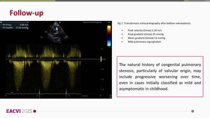Late progression of congenital pulmonary stenosis in adulthood: insights from multimodality imaging – a case report