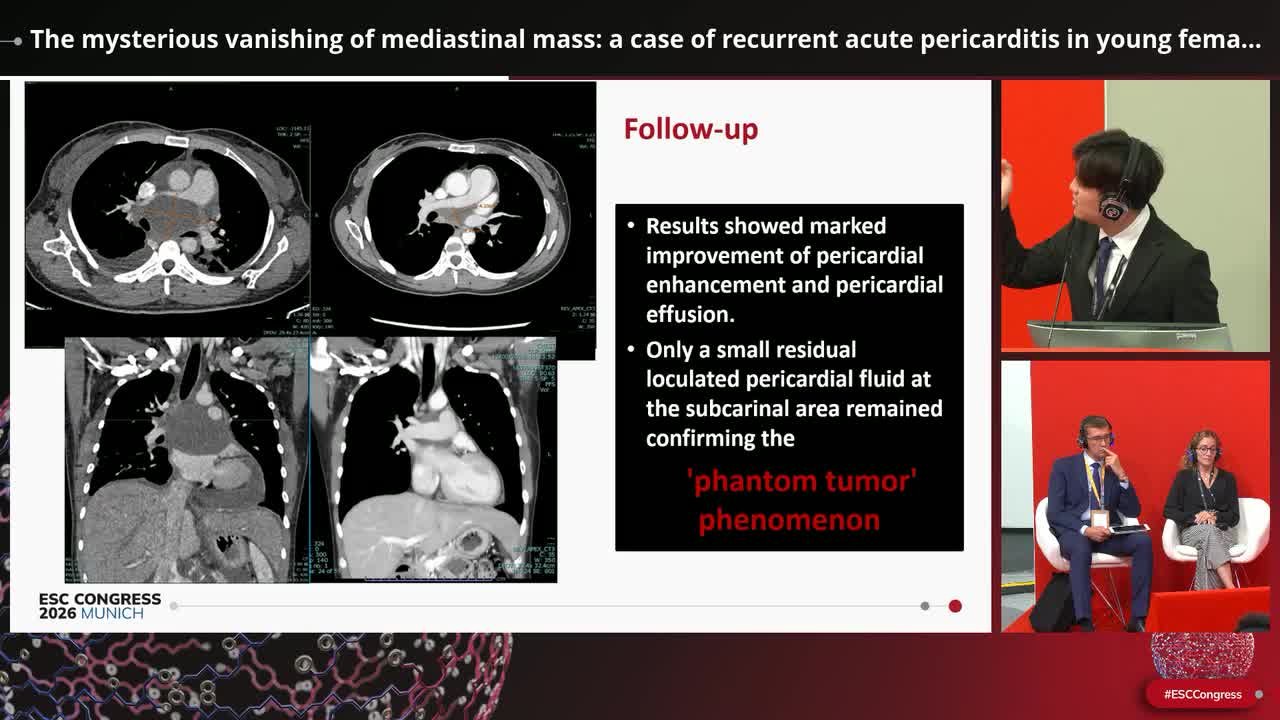 The mysterious vanishing of mediastinal mass: a case of recurrent acute pericarditis in young female patient