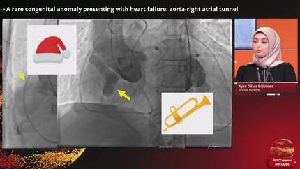 Rare and unusual cases of cardiomyopathies and heart failure (4)