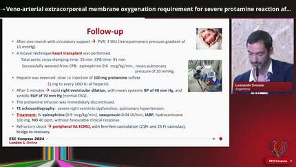 Veno-arterial extracorporeal membrane oxygenation requirement for severe protamine reaction after heart transplant