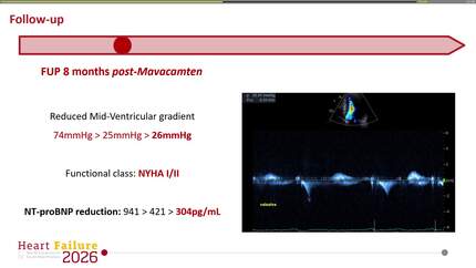 Expanding the role of myosin inhibition: mavacamten in apical hypertrophic cardiomyopathy with mid-ventricular obstruction