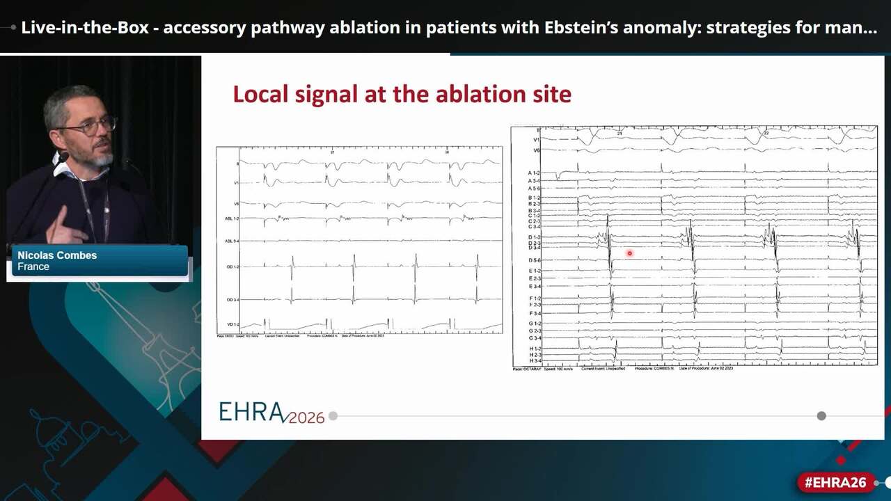 Live-in-the-Box - accessory pathway ablation in patients with Ebstein’s anomaly: strategies for management in the electrophysiology laboratory
