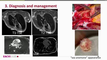 Incidental diagnosis of pulmonary valve fibroelastoma: a multimodality imaging approach