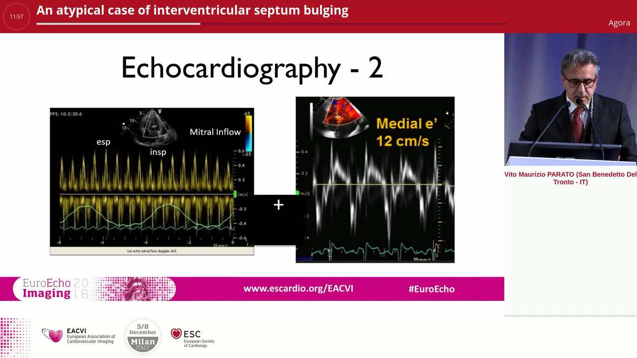 An atypical case of interventricular septum bulging