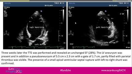 One serious complication after myocardial infarction, isn't that enough?