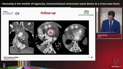 Necessity is the mother of ingenuity. Unconventional ventricular assist device to a Criss-cross heart.