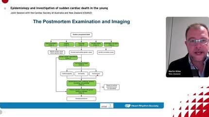 Guideline-based investigation and management of sudden cardiac death in the young.