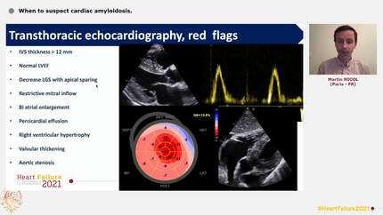 When to suspect cardiac amyloidosis.