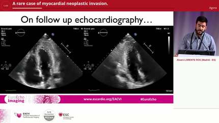 A rare case of myocardial neoplastic invasion.