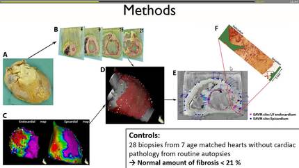 Electroanatomical voltage mapping validated by full human heart histology in non-ischemic cardiomyopathy