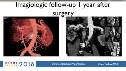 A reversible cause of heart failure: a vascular dilemma