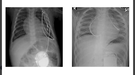 The bail out option; using endocardial pacing and defibrillation leads epicardially