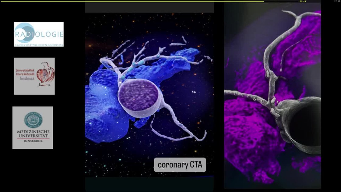 ESC 365 - Cardiac CT for redo prosthetic valve surgery
