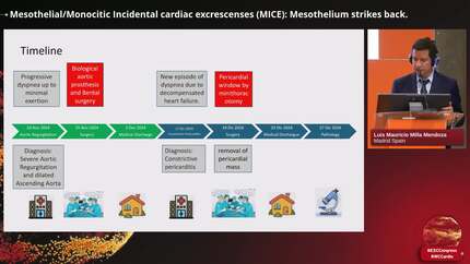 Mesothelial/Monocitic Incidental cardiac excrescenses (MICE): Mesothelium strikes back. 