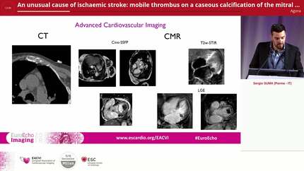 An unusual cause of ischaemic stroke: mobile thrombus on a caseous calcification of the mitral annulus