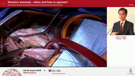 Ebstein’s anomaly – when and how to operate?