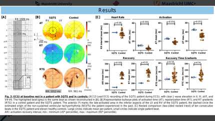 Characterization of static and dynamic depolarization and repolarization characteristics in the short-QT syndrome