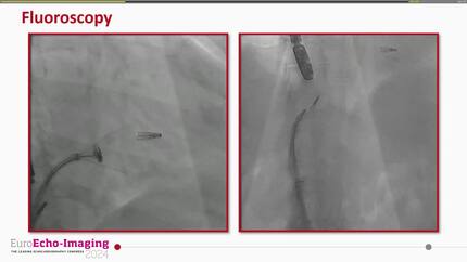 Percutaneous excision of failed MitraClip in the tricuspid valve position 