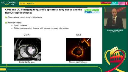 Epicardial fatty tissue derived by cardiac magnetic resonance imaging is related to coronary plaque vulnerability as assessed by optical coherence tomography in patients with type 2 diabetes 