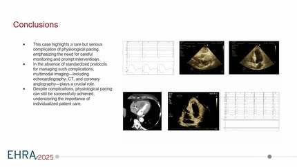 Challenges in conduction system pacing: case study of interventricular septal hematoma