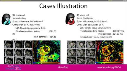 Myocardial fibrosis in rheumatic mitral stenosis: quantitative evaluation by T1 mapping