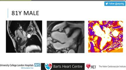 CMR in contemporary cardio-oncology
