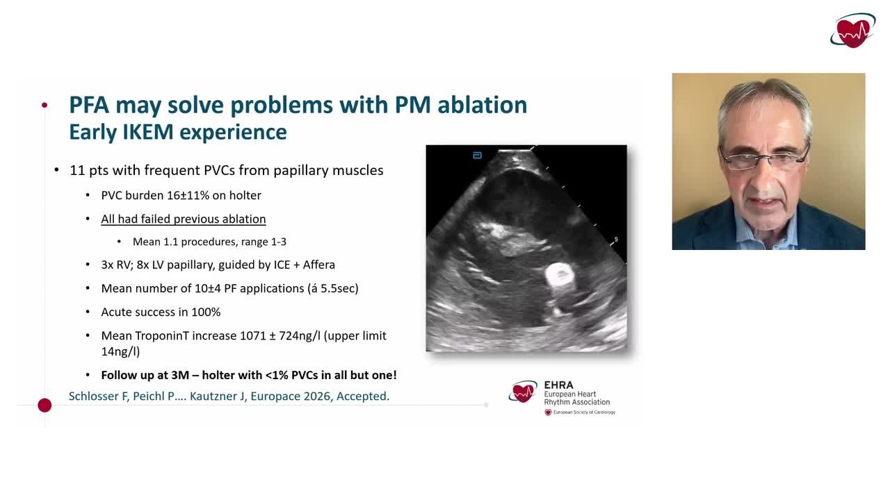 Pulsed field ablation of ventricular arrhythmias