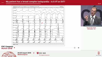My patient has a broad complex tachycardia – Is it VT or SVT?
