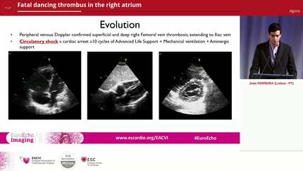 Fatal dancing thrombus in the right atrium