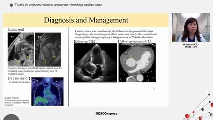 Totally thrombosed valsalva aneurysm mimicking cardiac tumor.