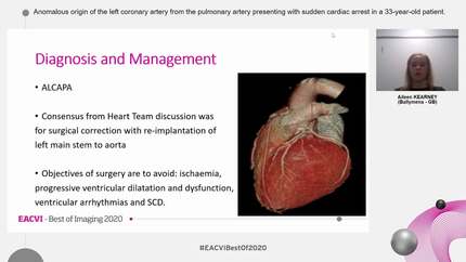 Anomalous origin of the left coronary artery from the pulmonary artery presenting with sudden cardiac arrest in a 33-year-old patient.