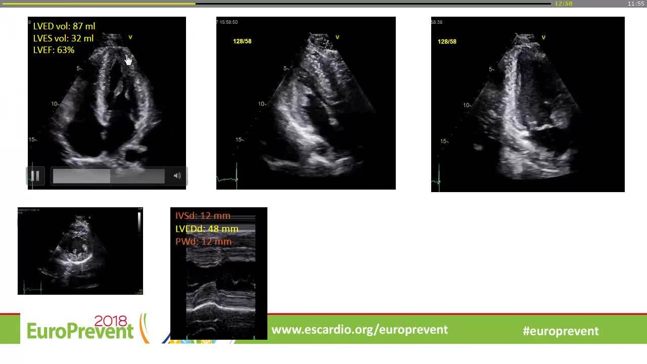 T-wave inversion on ECG but normal echo. What next?