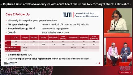 Ruptured sinus of valsalva aneurysm with acute heart failure due to left-to-right shunt: 2 clinical cases