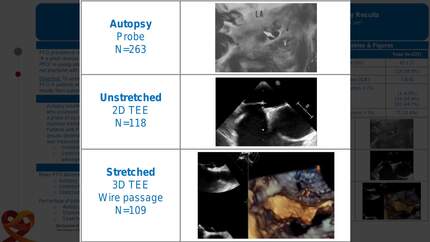 Anatomical features of PFO in patients with cryptogenic stroke in comparison to autopsy results