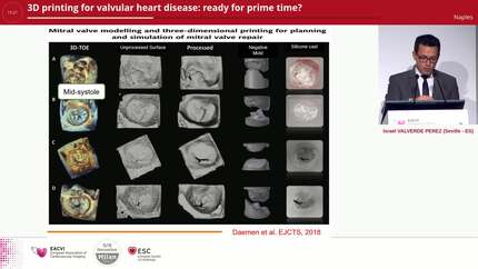 3D printing for valvular heart disease: ready for prime time?