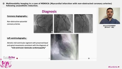 Multimodality imaging in a case of MINOCA (Myocardial infarction with non-obstructed coronary arteries) following anaesthetic induction.