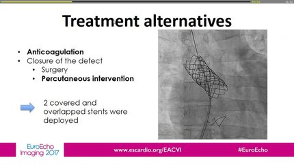 Transient ischemic attack in a young man with surgically corrected transposition of the great arteries